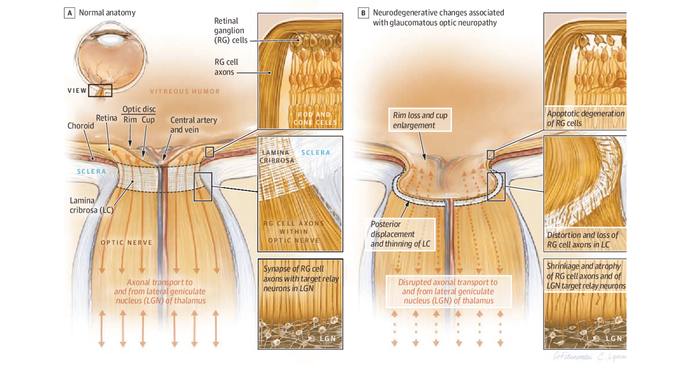 how-does-optic-nerve-ganglion-cell-damage-occur-glaucoma-australia